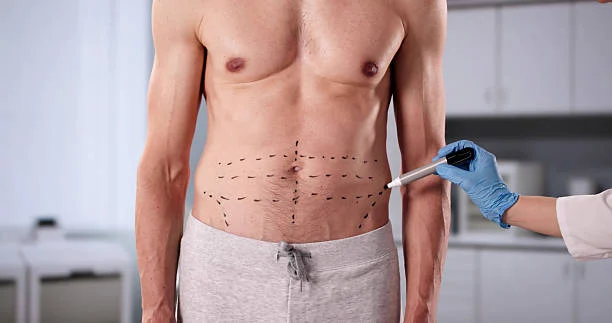 Modern Liposuction Techniques