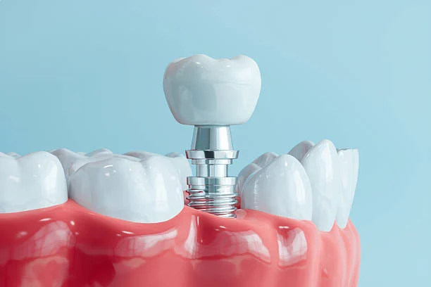 Dental Implants: When Is the Best Solution Instead of Bridges?