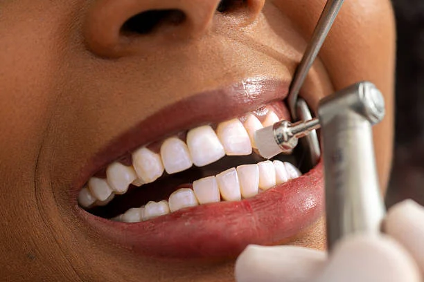 When Is Teeth Whitening Completely Safe?