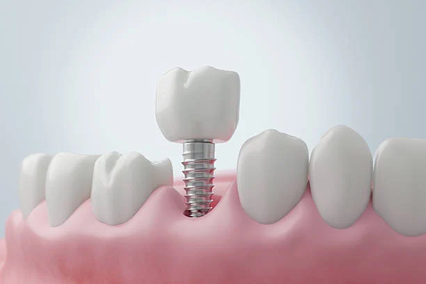 What are dental implants?