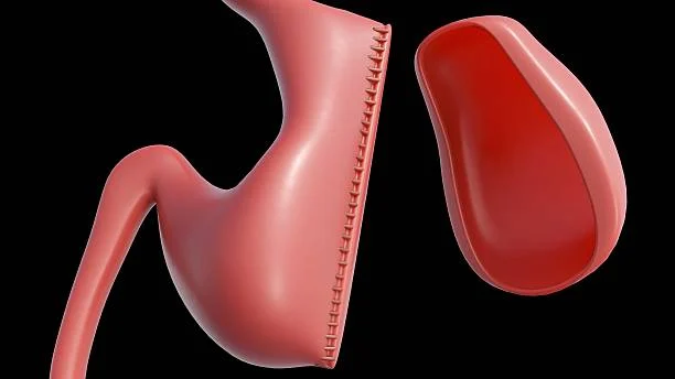 Gastric Sleeve and Gastric Bypass
