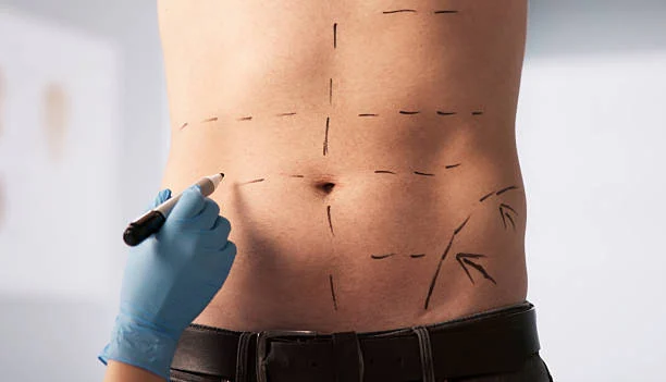 Liposuction and Body Contouring