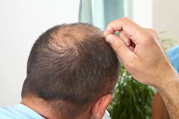 Hair Gaps and Hair Loss Treatment