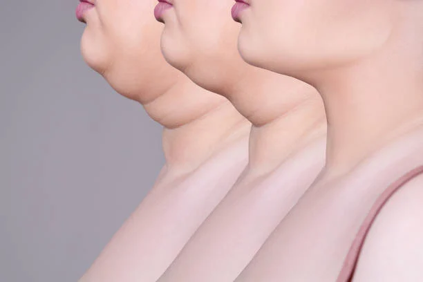 Cases Where Facelift with Neck Lift Is Recommended