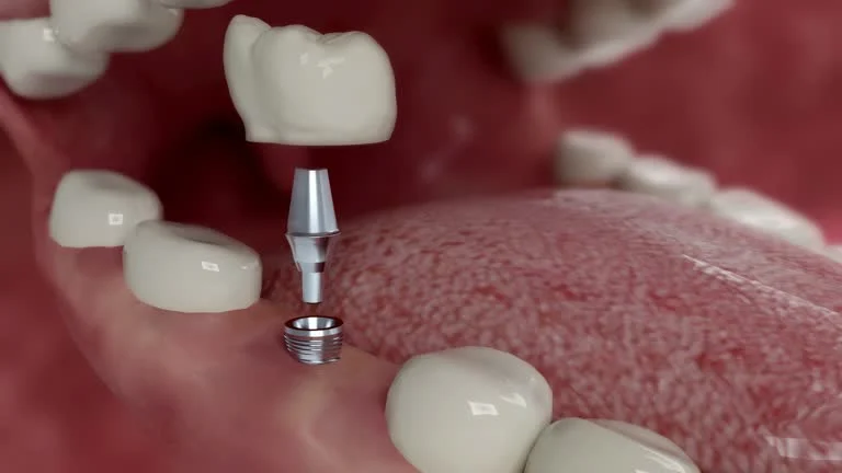 Type 2: Subperiosteal Implants (Above the Bone)