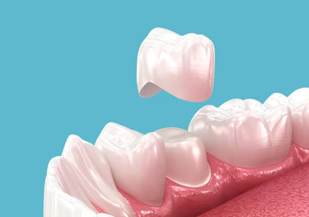 When Do You Need to Replace an Old Dental Crown?