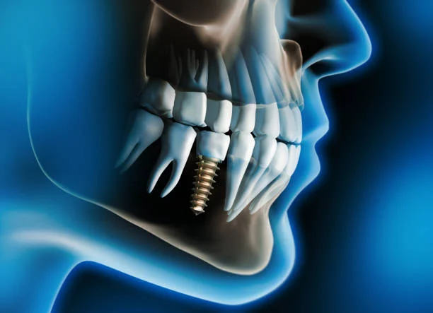Complications That May Lead to Implant Loss
