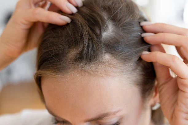 Nutrition and Its Role in Hair Transplant Care During the First 30 Days