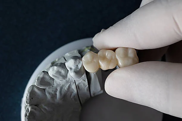 Average Lifespan of a Dental Crown