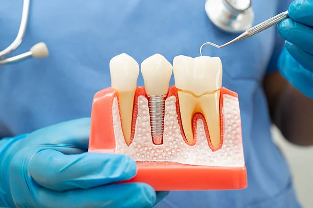 All-on-4 and All-on-6 Technique for Full Jaw