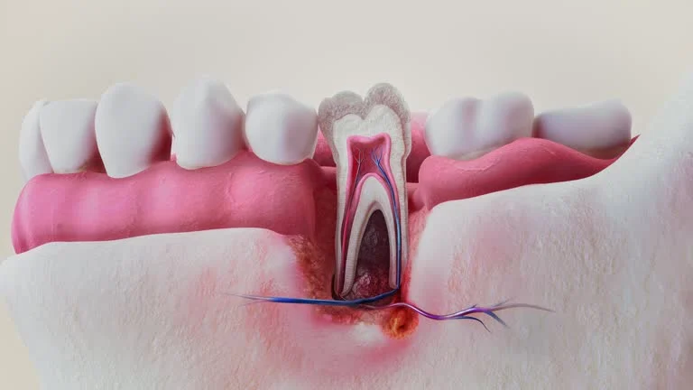 Gap Between Crown and Tooth